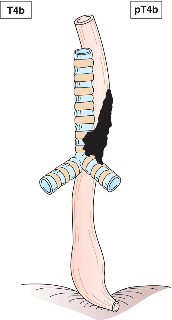 Schematic illustration of tumour invades other adjacent structures such as aorta, vertebral body or trachea.