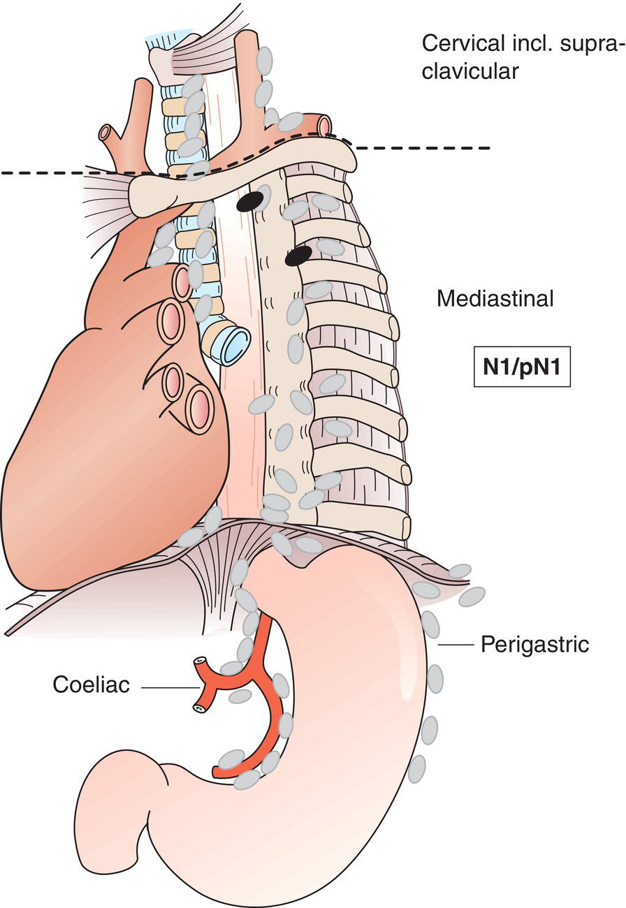 Schematic illustration of Metastasis in 1 to 2 regional lymph nodes.