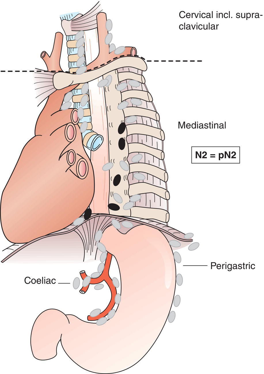 Schematic illustration of Metastasis in 3 to 6 regional lymph nodes.