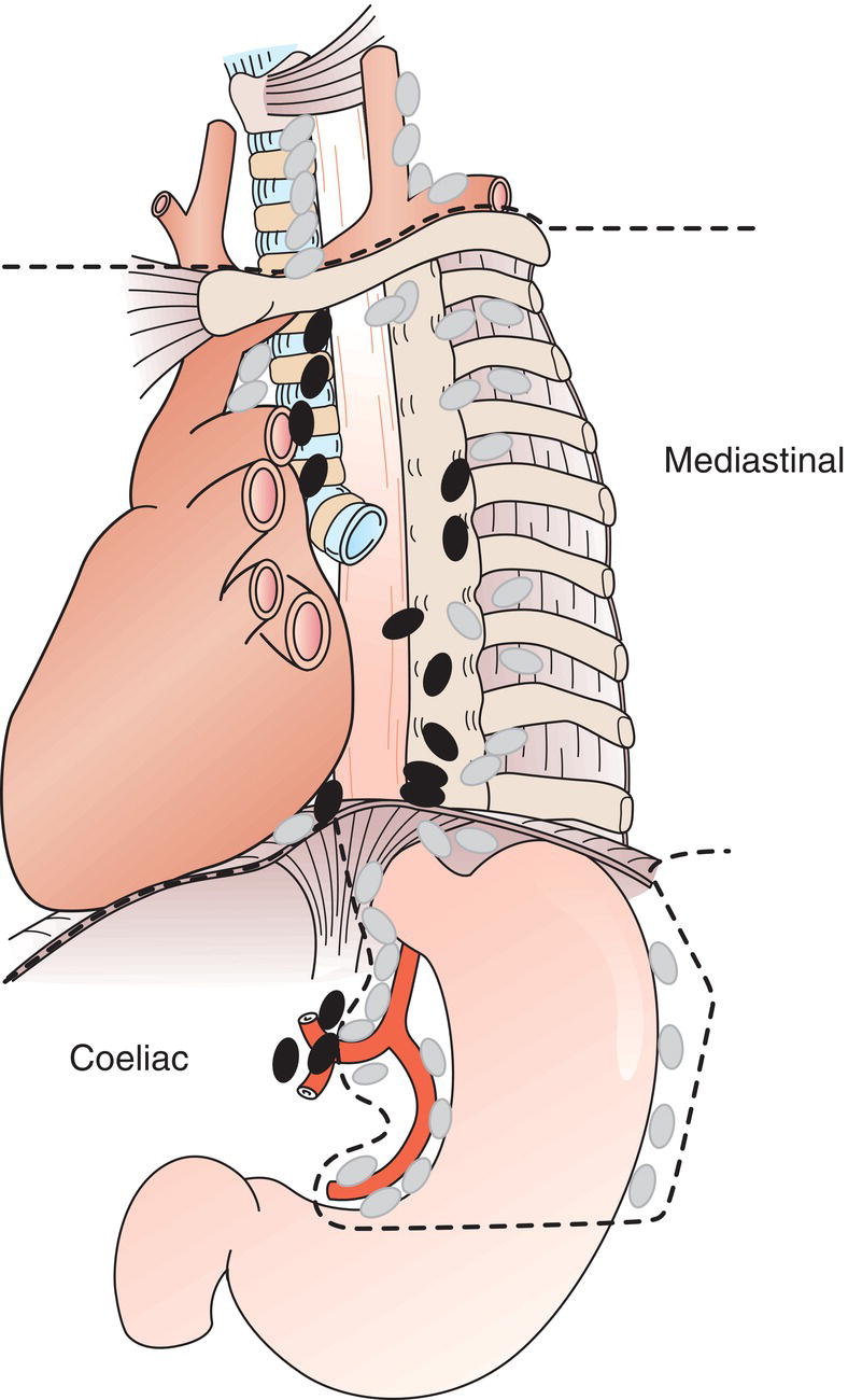 Schematic illustration of Metastasis in 7 or more regional lymph nodes.