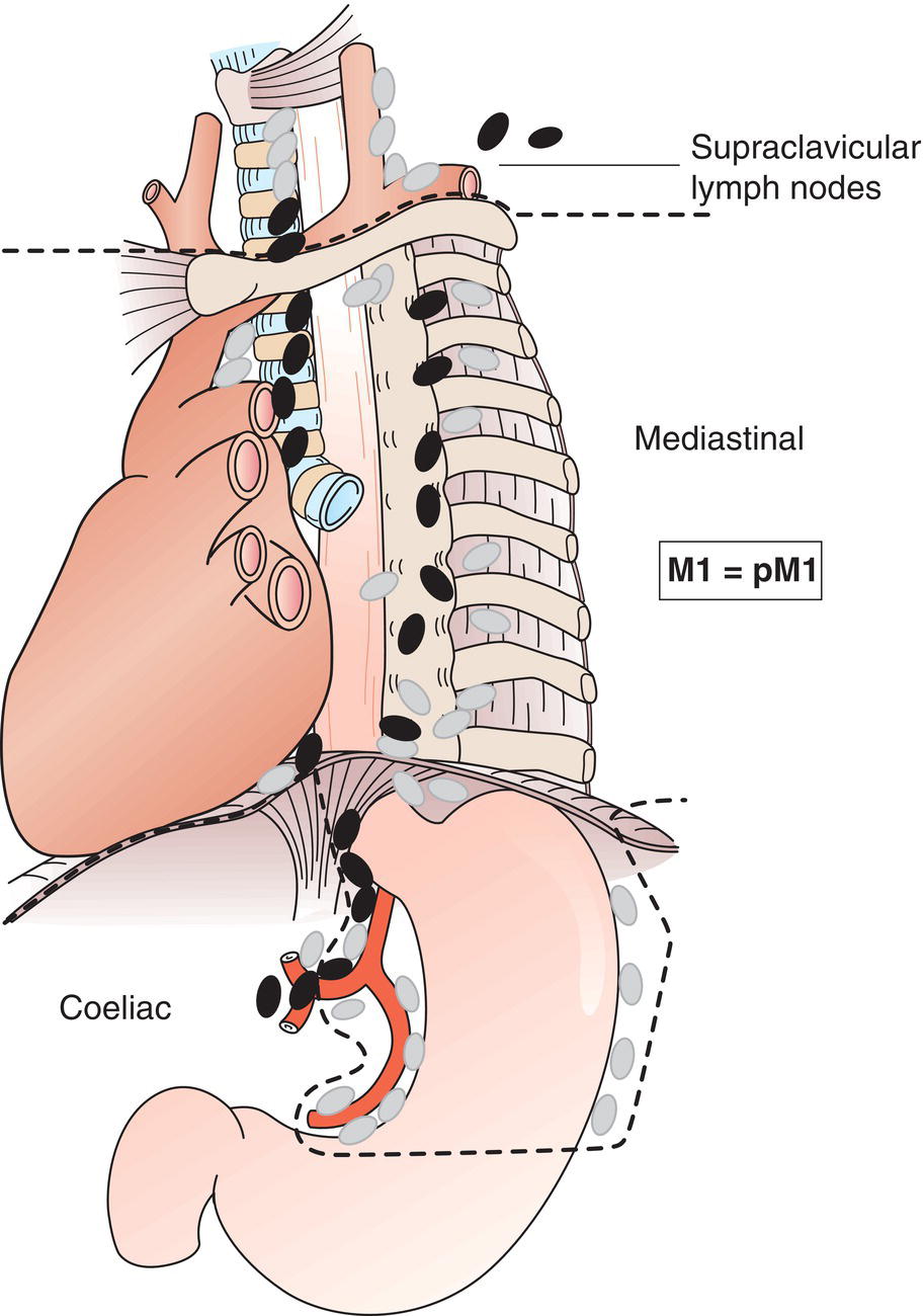 Schematic illustration of Distant metastasis.