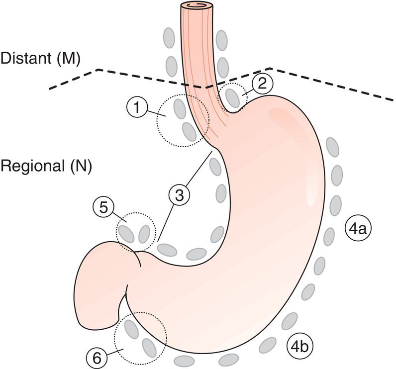 Schematic illustration of Regional Lymph Nodes.