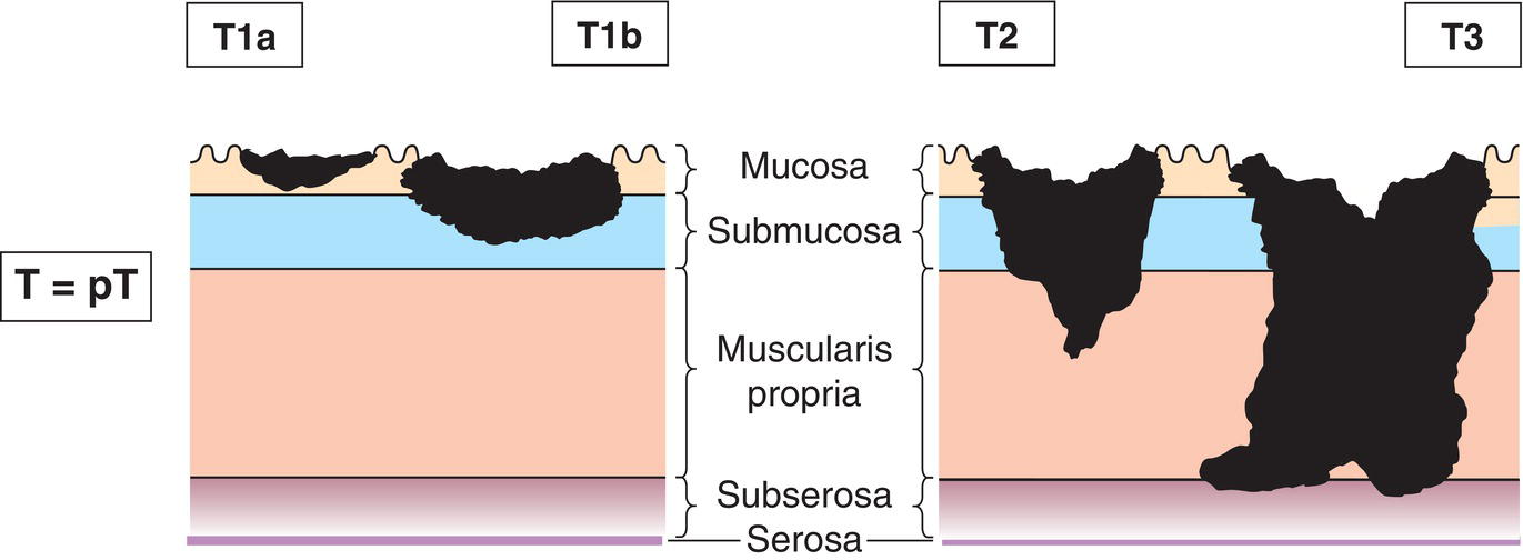 Photo depicts a Tumour invades lamina propria, muscularis mucosae or submucosa.