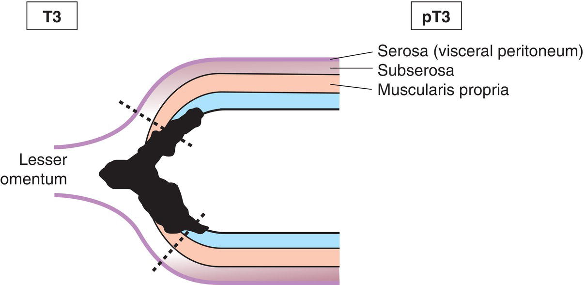 Photo depicts a Tumour invades subserosa.