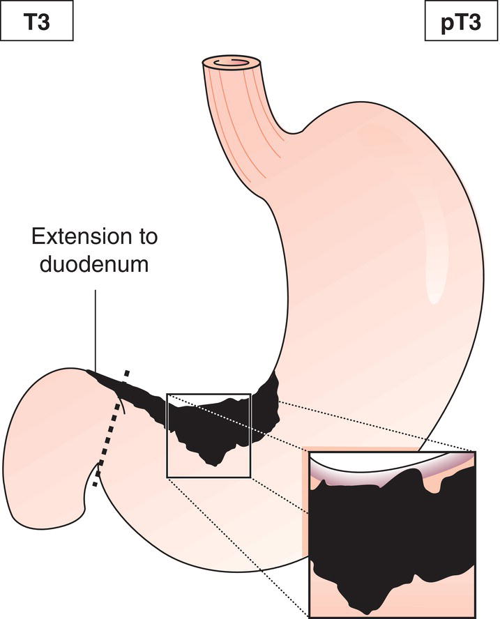 Schematic illustration of tumour invades subserosa.