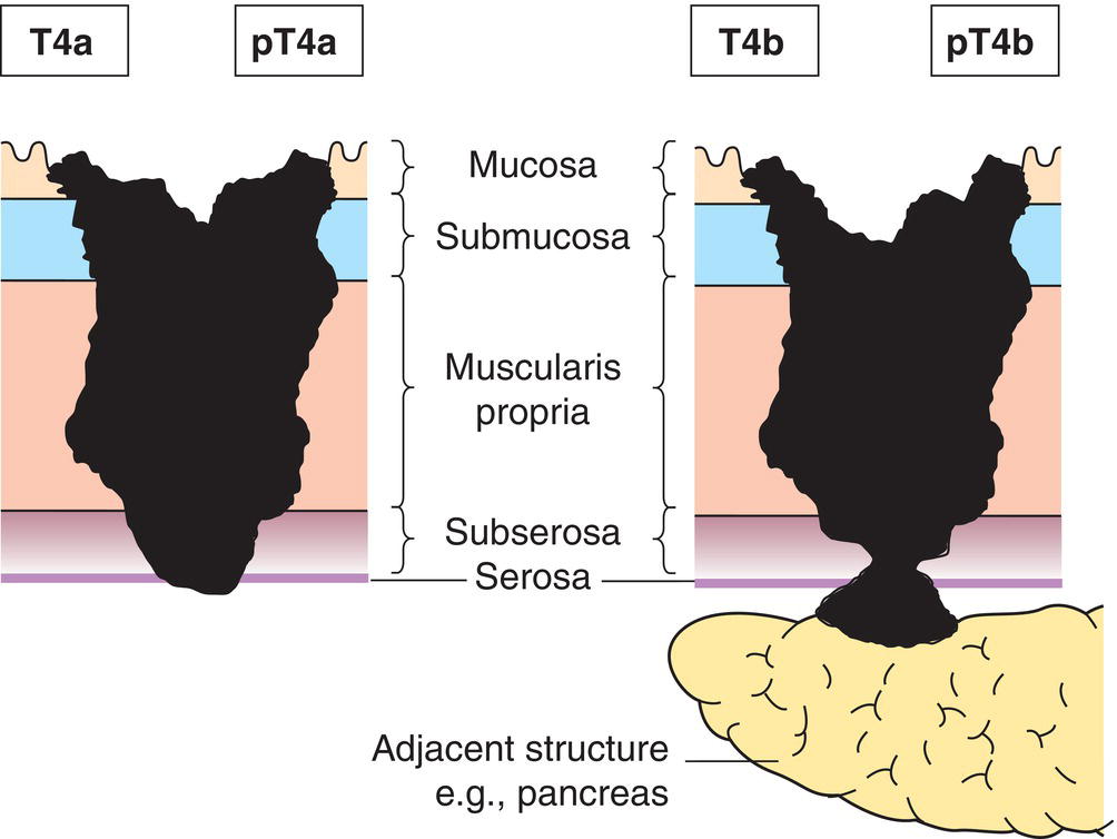 Photo depicts a Tumour invades adjacent structures.