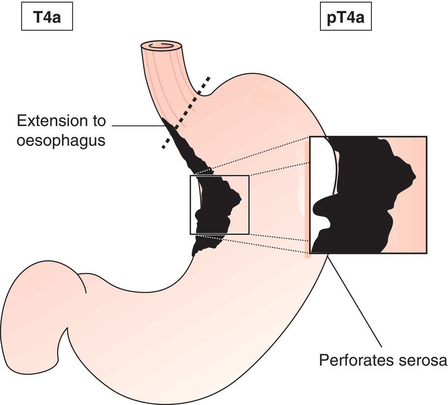 Schematic illustration of Intramural extension to the duodenum or oesophagus is classified by the depth of greatest invasion in any of these sites including the stomach.