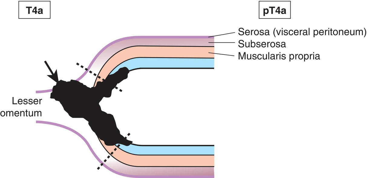 Photo depicts a Tumour that extends into gastrocolic or gastrohepatic ligaments or into greater or lesser omentum, without perforation of visceral peritoneum, is T3.