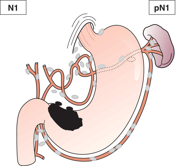 Schematic illustration of Metastasis in 1 to 2 regional lymph nodes.