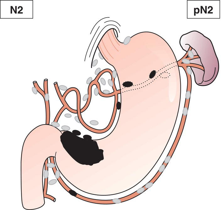 Schematic illustration of Metastasis in 3 to 6 regional lymph nodes.