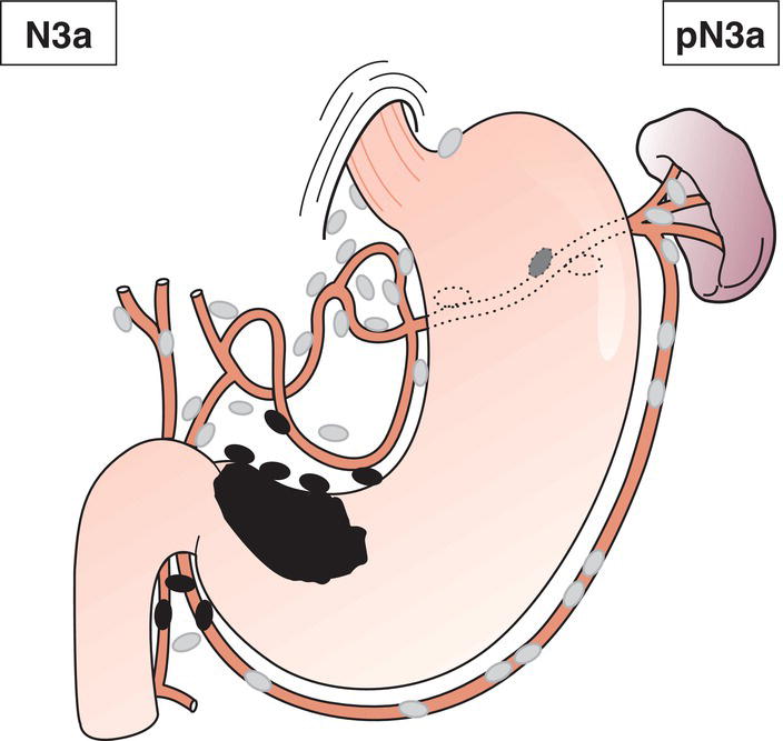 Schematic illustration of Metastasis in 7 to 15 regional lymph nodes.