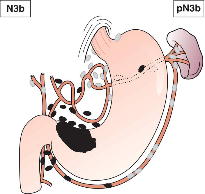 Schematic illustration of Metastasis in 16 or more regional lymph nodes.