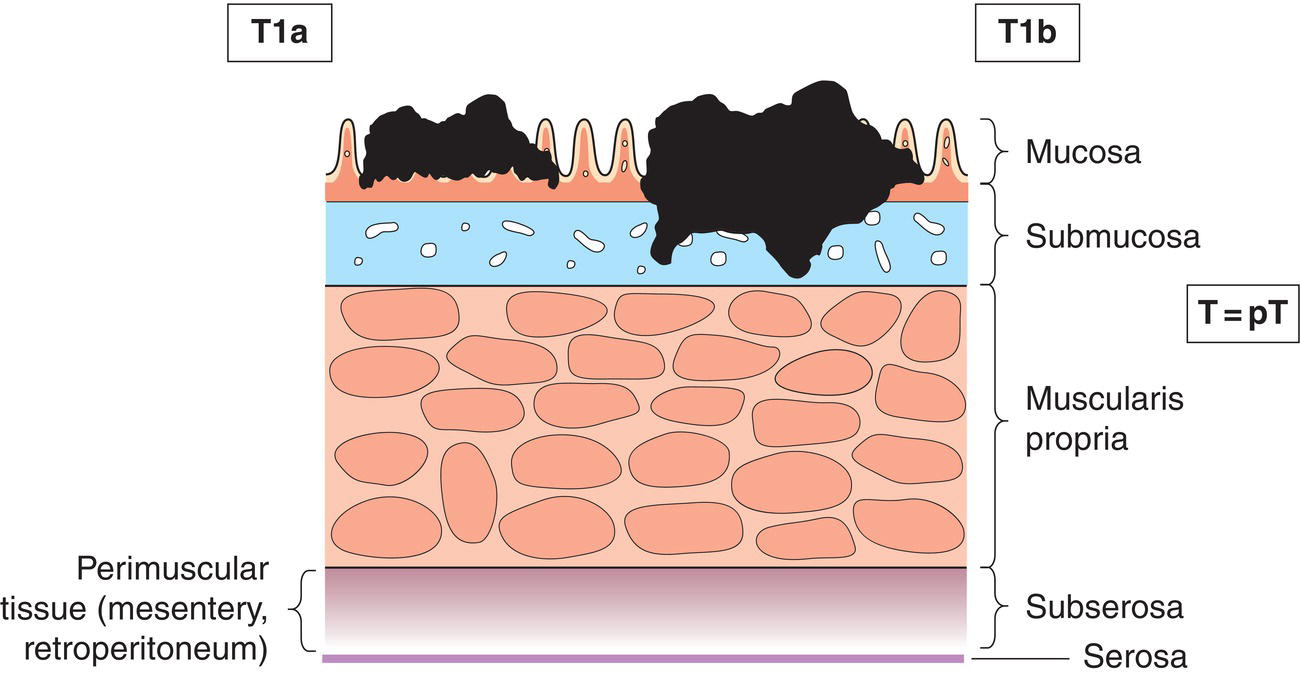 Photo depicts a Tumour invades lamina propria, muscularis mucosae or submucosa.