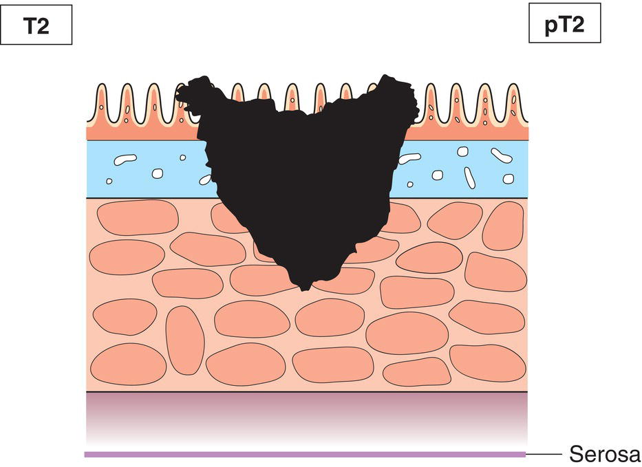 Photo depicts a Tumour invades muscularis propria.