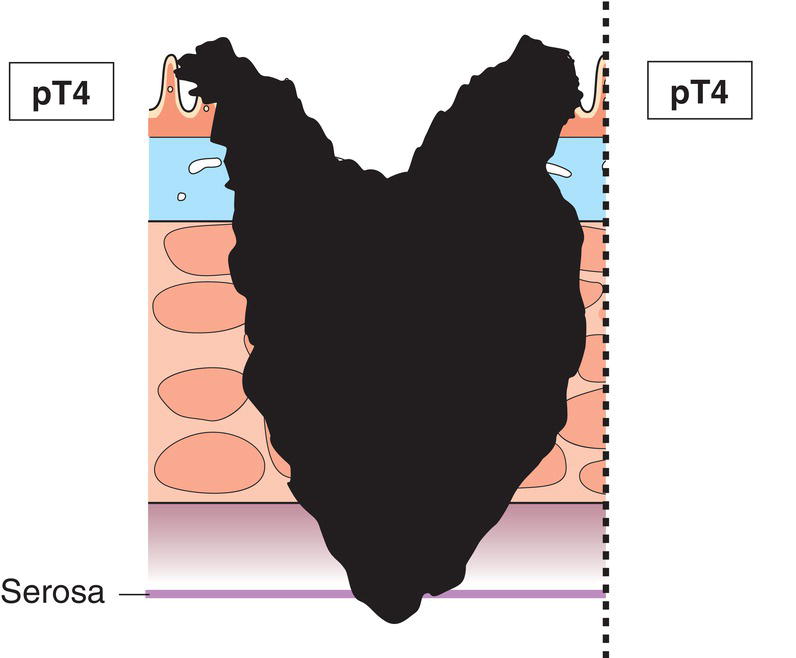 Photo depicts a Tumour perforates visceral peritoneum or directly invades other organs or structures.