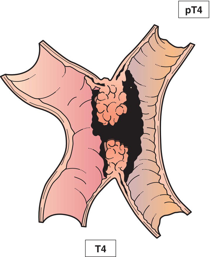 Photo depicts a Tumour perforates visceral peritoneum or directly invades other organs or structures.