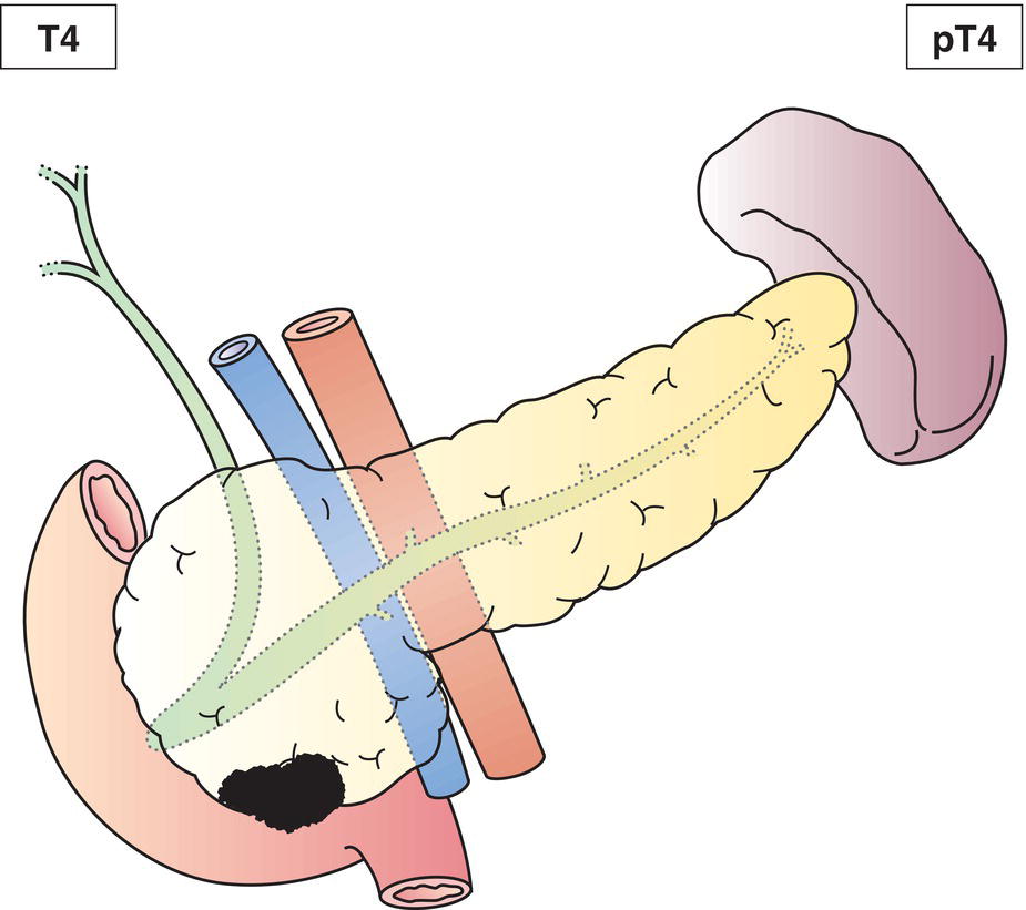 Photo depicts a Tumour perforates visceral peritoneum or directly invades other organs or structures.