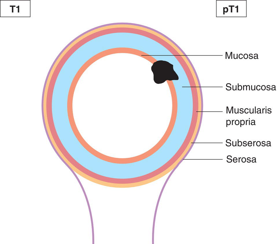 Schematic illustration of tumour invades submucosa.