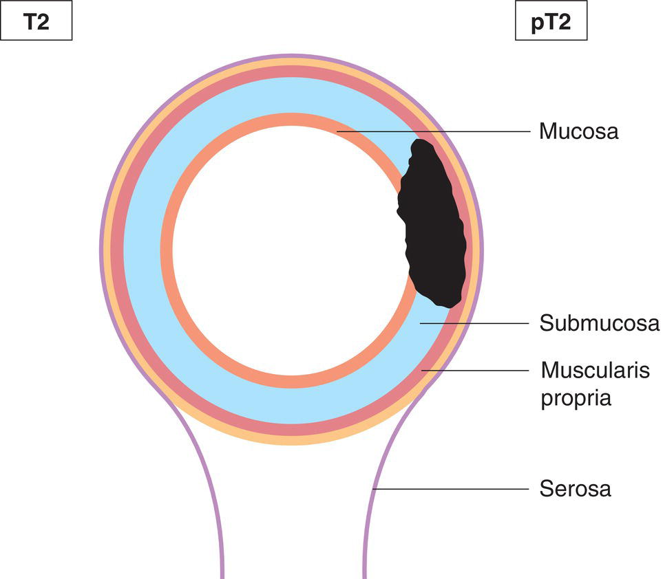 Schematic illustration of tumour invades muscularis propria.