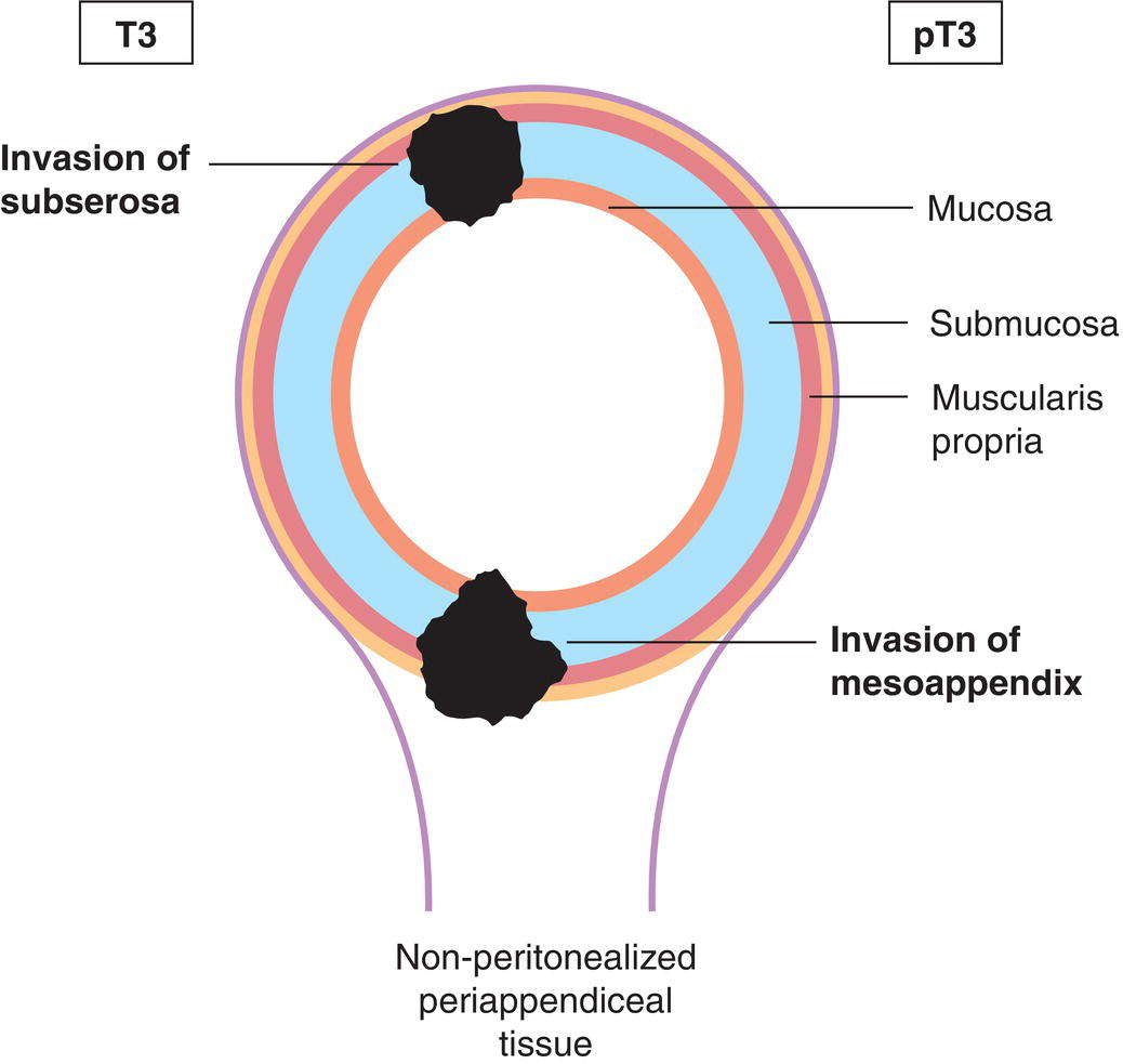 Schematic illustration of tumour invades subserosa or mesoappendix.