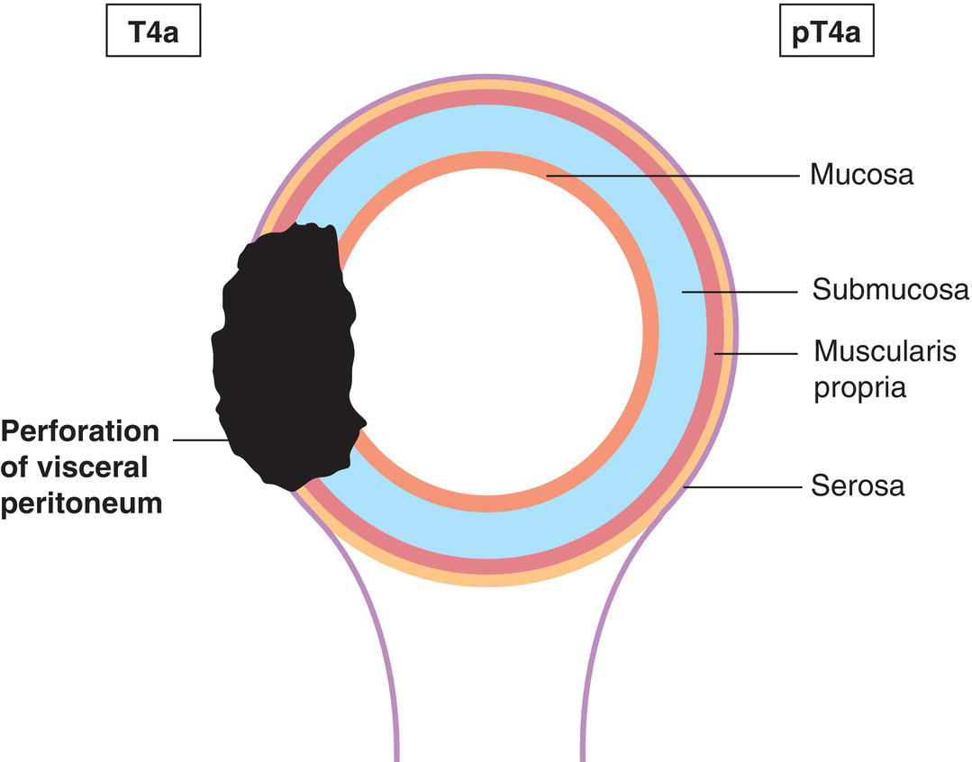 Schematic illustration of tumour perforates visceral peritoneum, including mucinous
peritoneal tumour within the right lower quadrant.