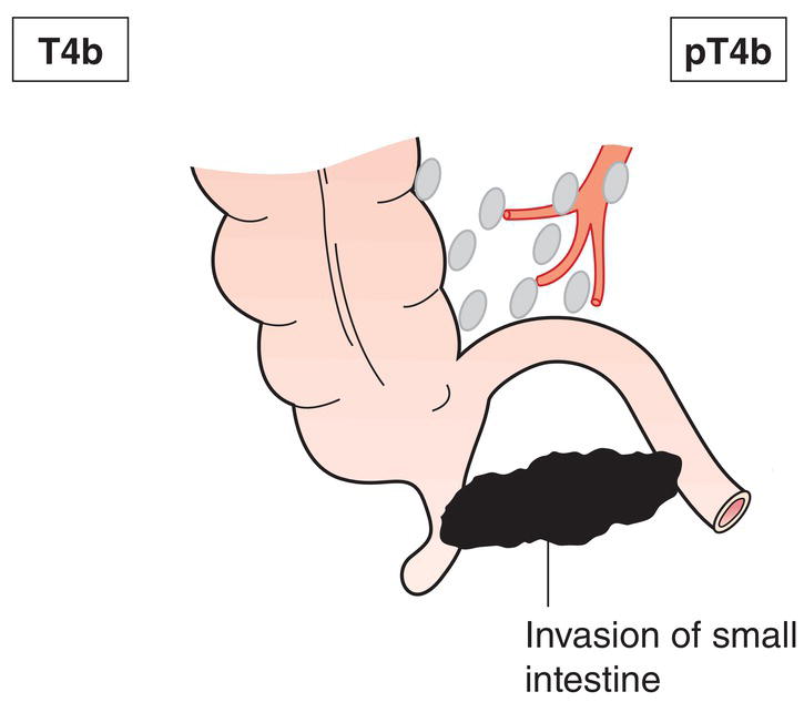 Schematic illustration of tumour perforates visceral peritoneum, including mucinous peritoneal tumour within the right lower quadrant and directly invades other organs or structures.