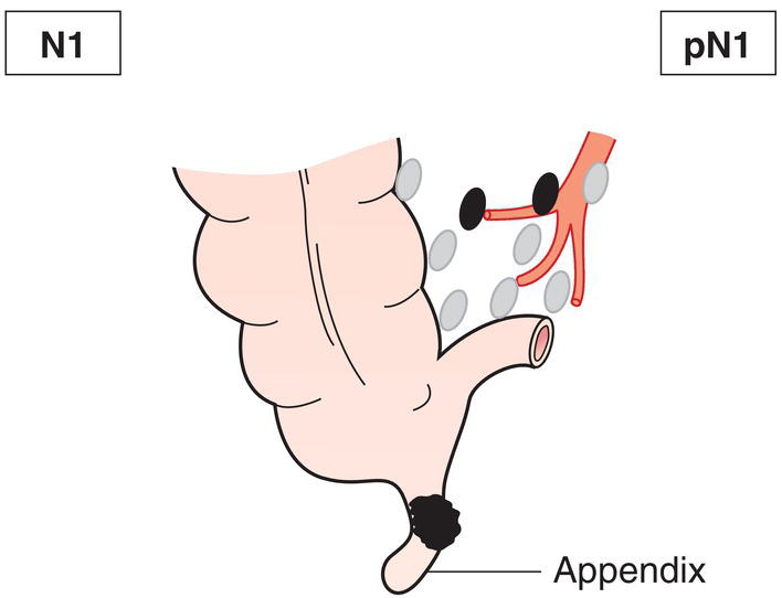 Schematic illustration of tumour directly invades other organs or structures.