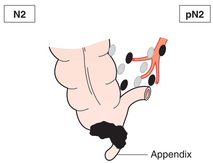 Schematic illustration of Metastasis in 4 or more regional lymph nodes.