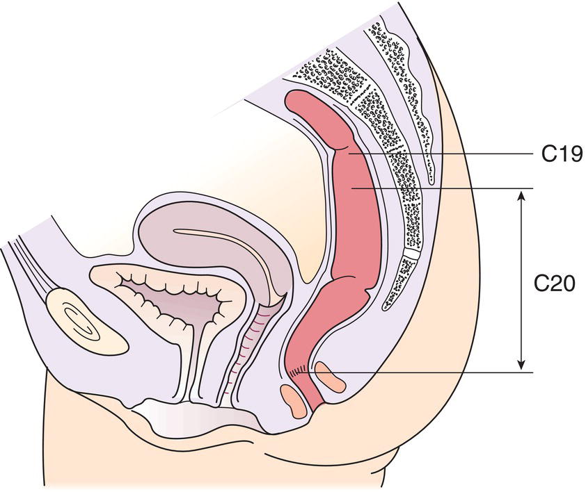 Schematic illustration of Rectosigmoid junction.