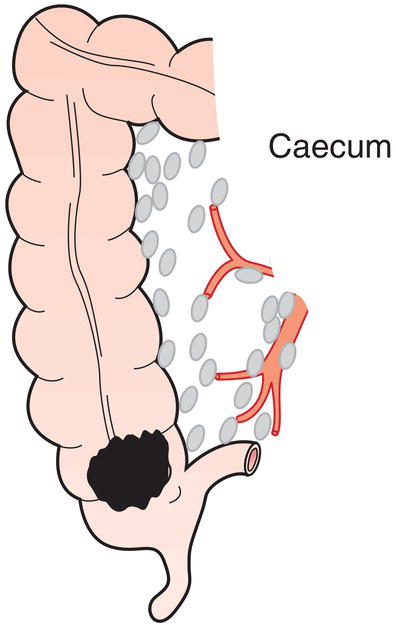 Schematic illustration of Ileocolic, right colic.