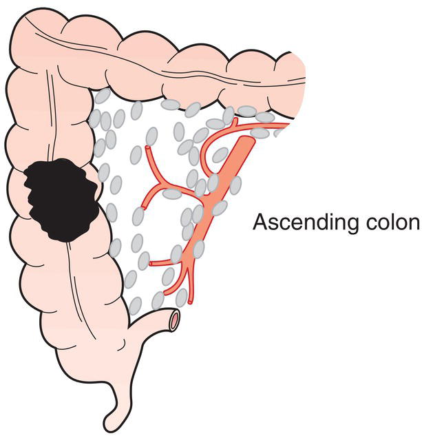 Schematic illustration of Ileocolic, right colic, middle colic.