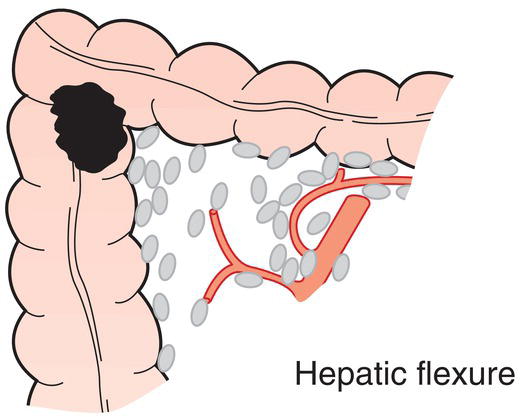 Schematic illustration of Middle colic, right colic.