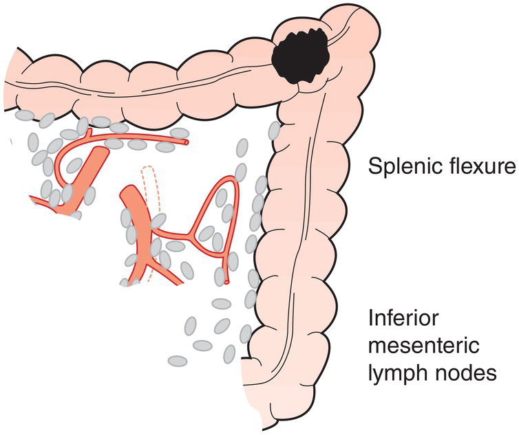 Schematic illustration of Middle colic, left colic, inferior mesenteric.