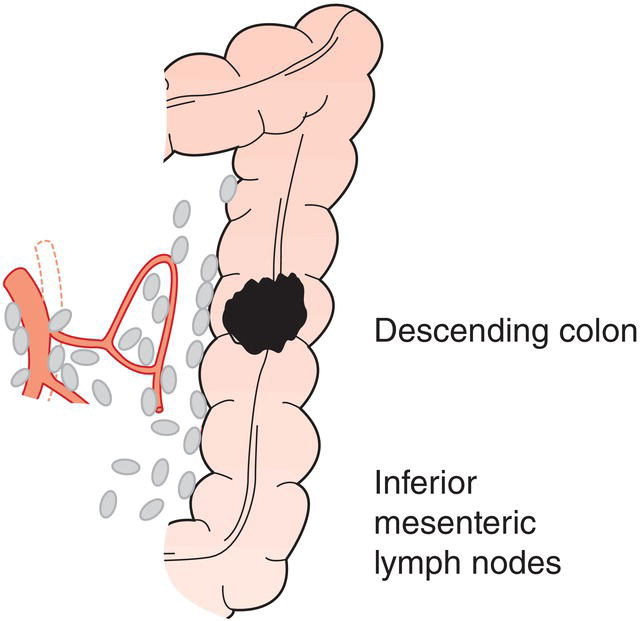 Schematic illustration of Left colic, inferior mesenteric.