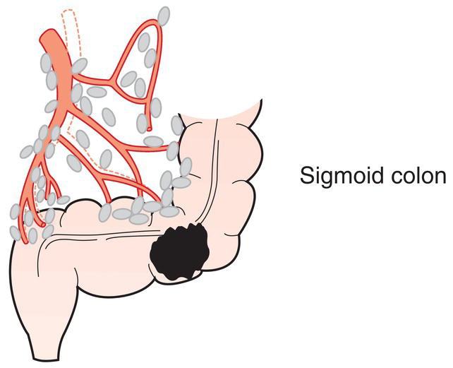 Schematic illustration of Sigmoid, left colic, superior rectal, inferior
mesenteric and rectosigmoid.