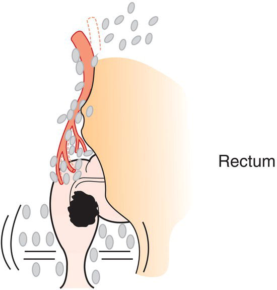 Schematic illustration of Superior, middle, and inferior rectal (haemorrhoidal), inferior
mesenteric, internal iliac, mesorectal (paraproctal), lateral sacral, presacral, sacral promontory.