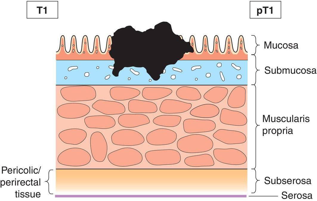 Schematic illustration of tumour invades submucosa.