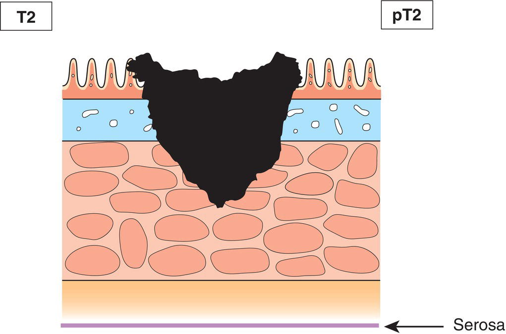 Schematic illustration of tumour invades muscularis propria.