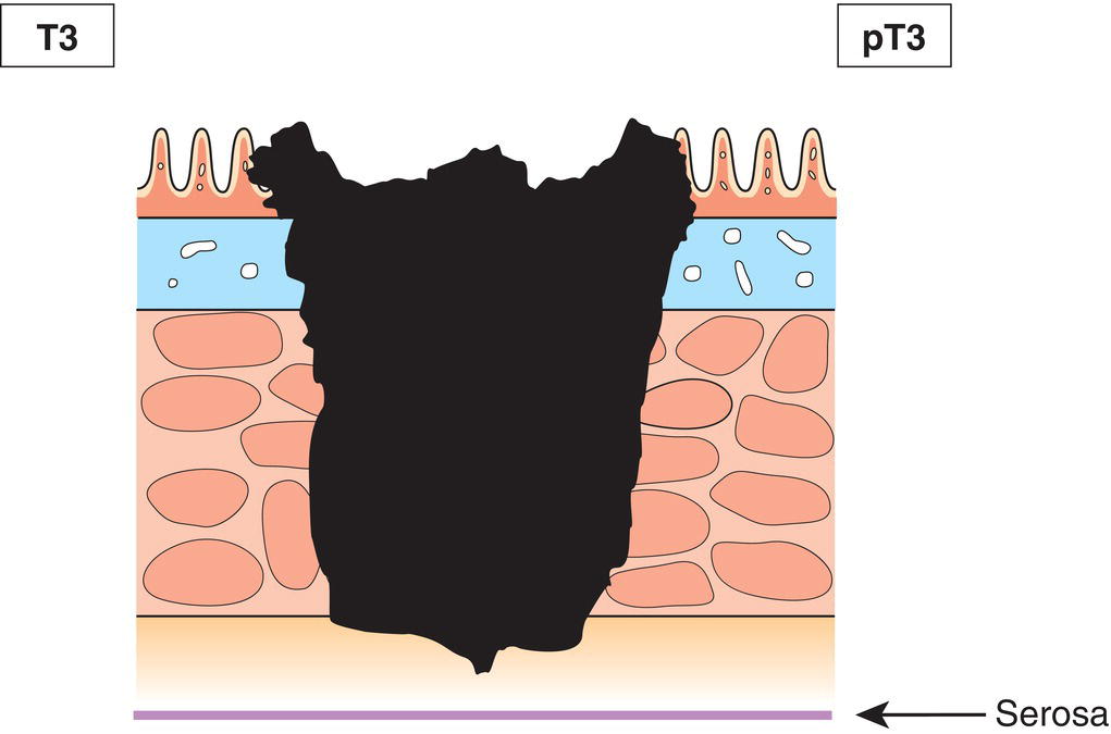 Schematic illustration of tumour invades subserosa or into non‐peritonealized pericolic or perirectal tissues.