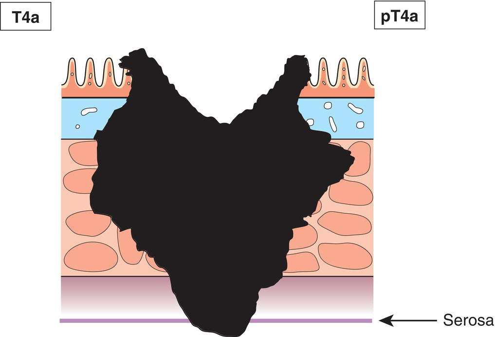 Schematic illustration of tumour directly invades other organs or structures 2,3,4 and perforates visceral peritoneum.