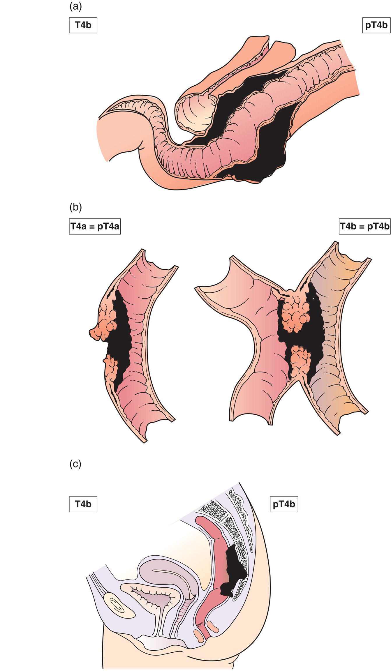 Schematic illustration of tumour directly invades other organs or structures 2,3,4 and perforates visceral peritoneum.