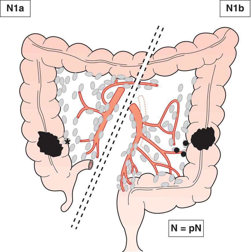 Schematic illustration of Metastasis in 1 to 3 regional lymph nodes.