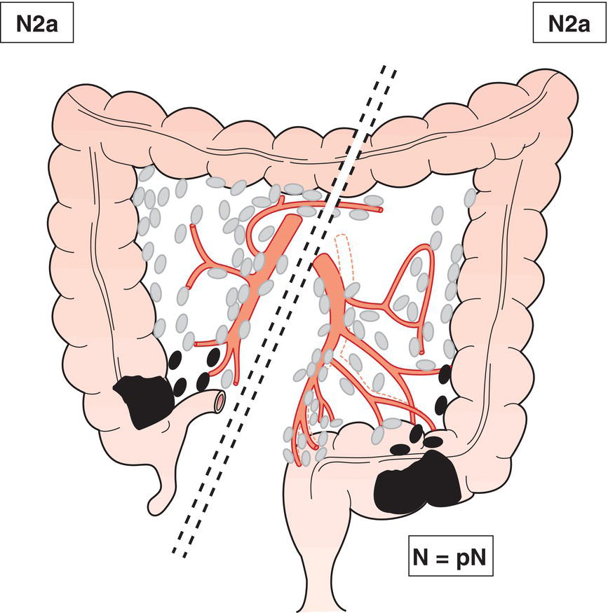 Schematic illustration of Metastasis in 4 or more regional lymph nodes.