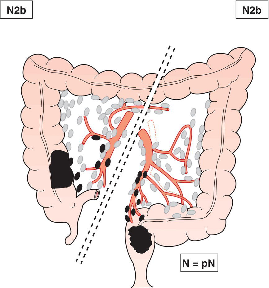 Schematic illustration of Metastasis in 4 to 6 regional lymph nodes.