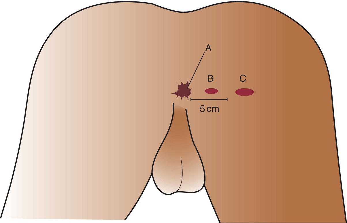 Schematic illustration of carcinomas of the anal canal.