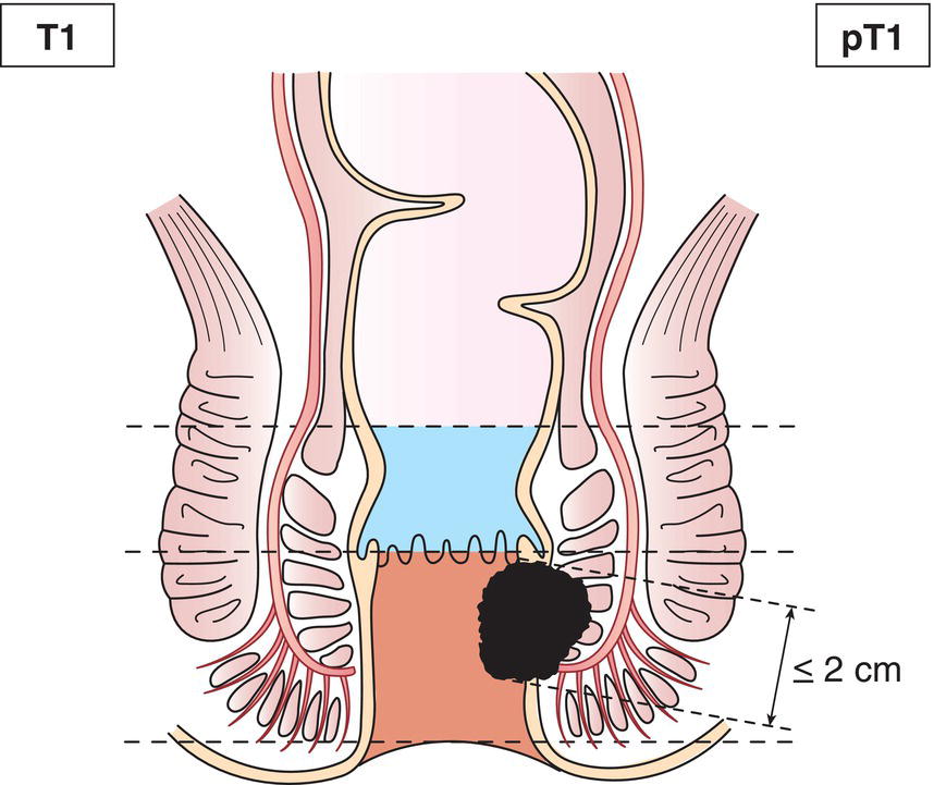 Schematic illustration of tumour 2 cm or less in greatest dimension.