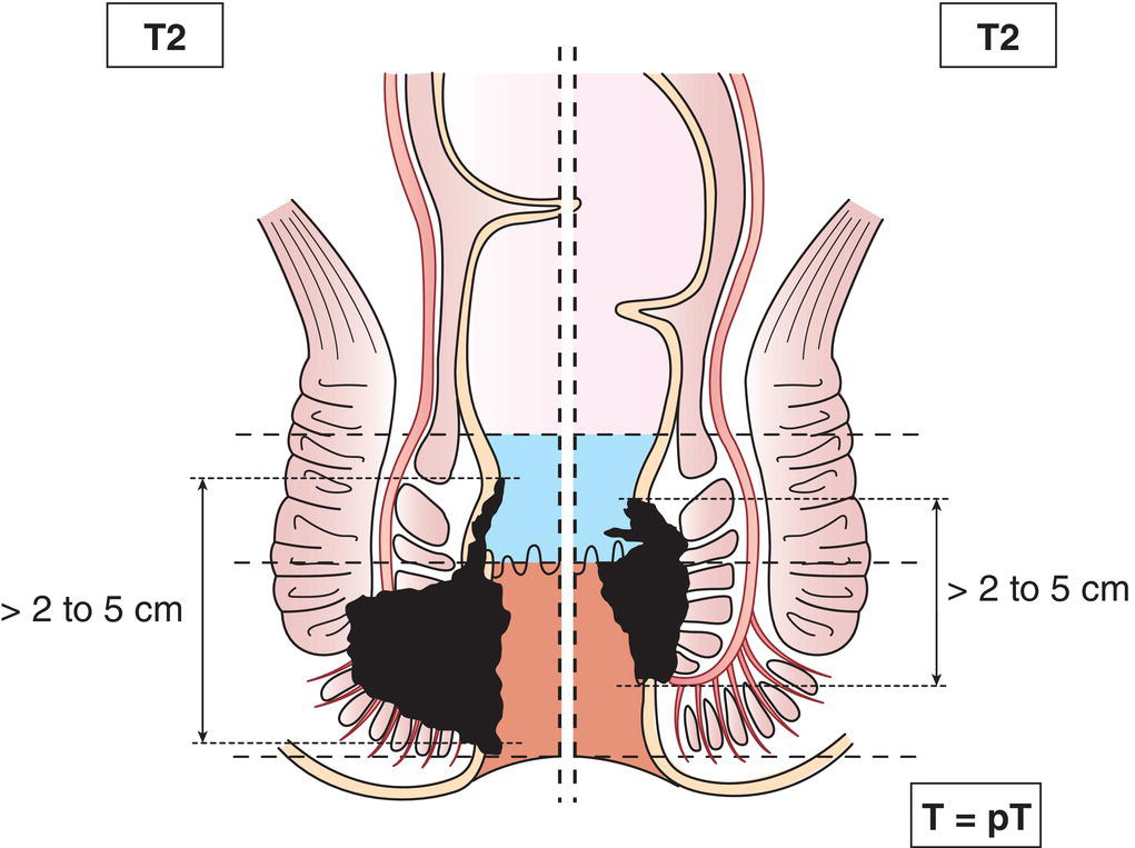 Schematic illustration of tumour more than 2 but not more than 5 cm in greatest dimension.