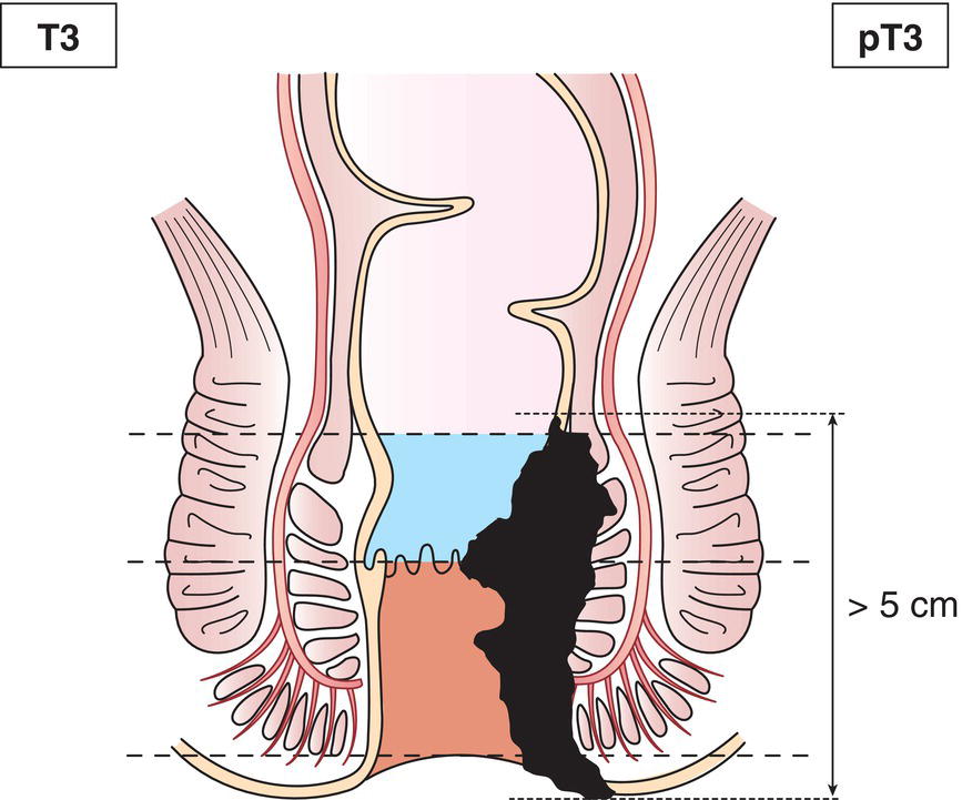 Schematic illustration of tumour of more than 5 cm in greatest dimension.