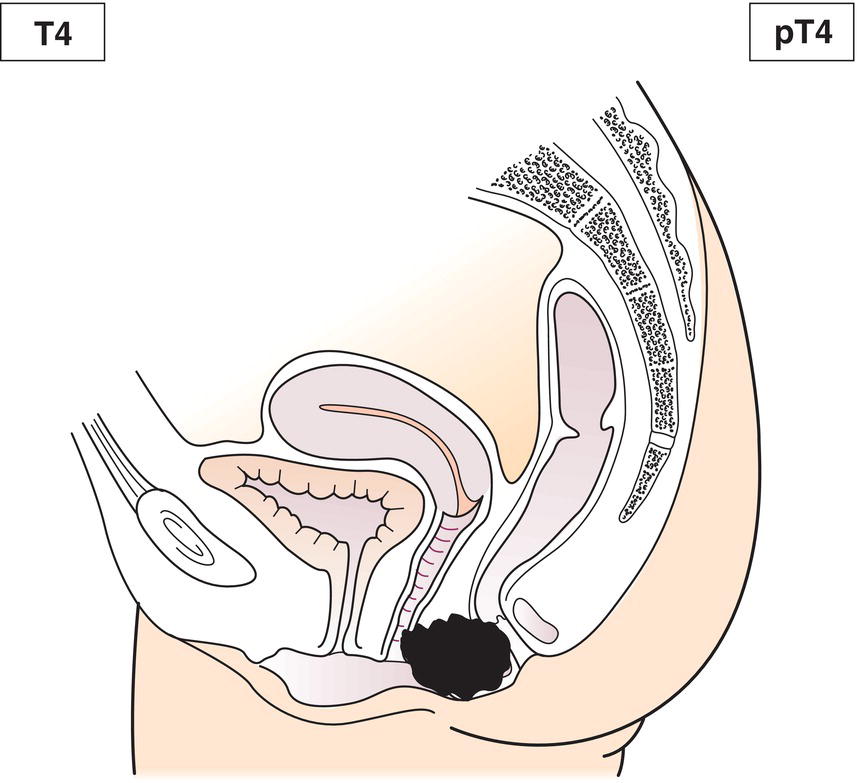 Schematic illustration of tumour of any size invades adjacent organ(s), e.g., vagina, urethra, bladder.