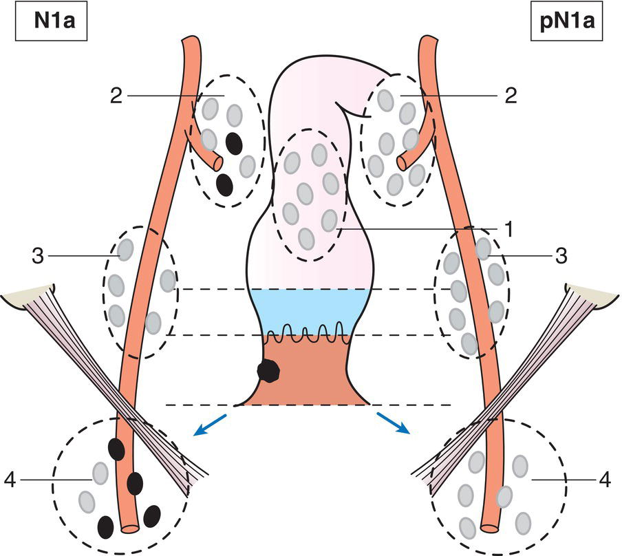 Schematic illustration of Metastases in inguinal, mesorectal and internal iliac nodes.